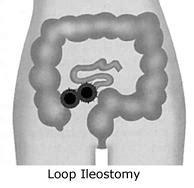 Loop/End Ileostomy