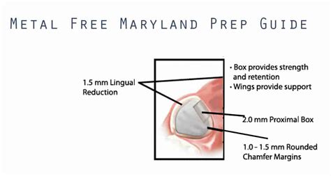 Single Tooth Restoration Options: Evaluating Maryland Bridges