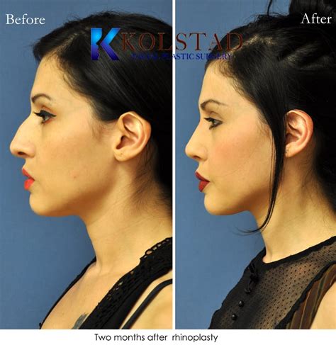 Mexican Nose Job San Diego - Dr. Kolstad Rhinoplasty Specialist