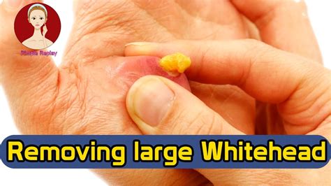 Removing large Whitehead | Pimple Replay | - YouTube