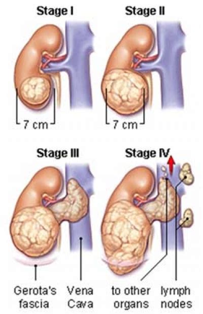 Cancer Stages