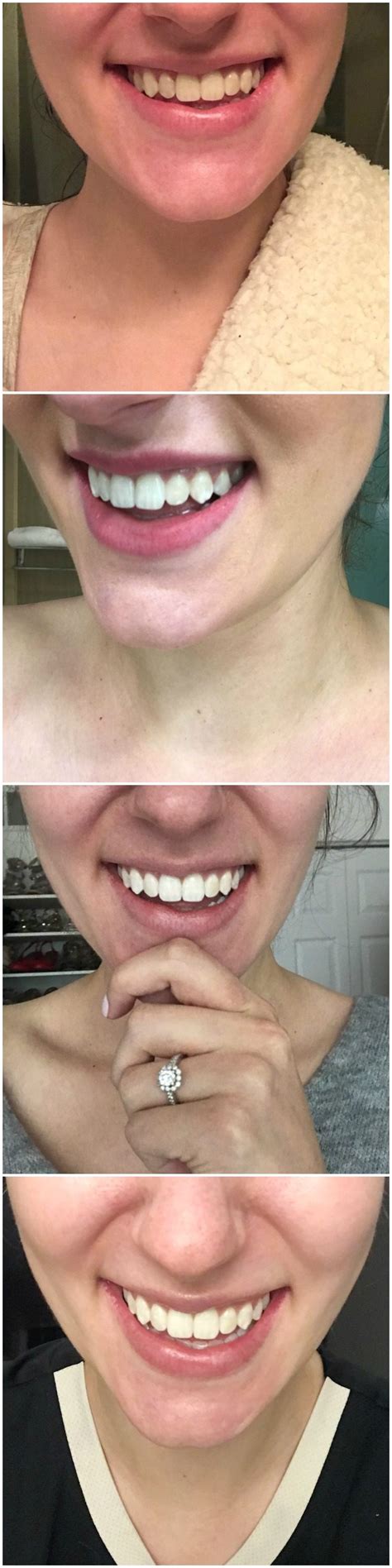 I wore Crest Whitestrips for 14 Days and here's what happened.