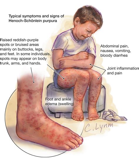 Henoch-Schönlein Purpura | Allergy and Clinical Immunology | JAMA ...