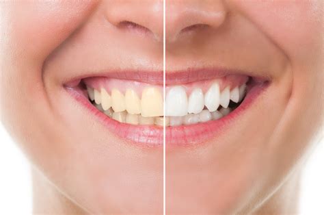 Teeth Whitening Near Me, Rush City MN 55069 - Soft Dental Blog - Tuyen ...