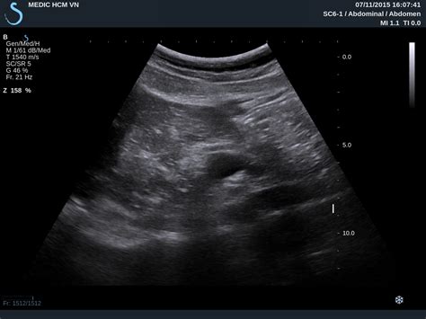 VIETNAMESE MEDIC ULTRASOUND: CASE 358: LESSER OMENTUM TUMOR, Dr PHAN THANH HAI , Dr VAN UYEN ...