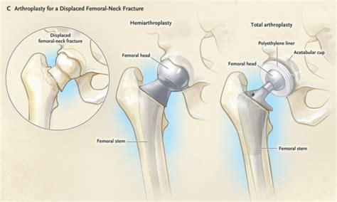 Hip HemiArthroplasty – What you need to know! – The Operating Room Global (TORG)