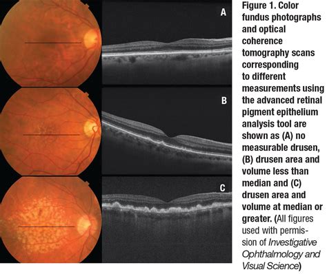 Macular Degeneration Drusen