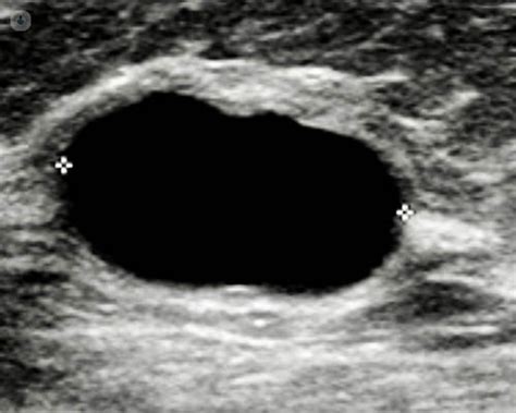 Breast Cyst Ultrasound