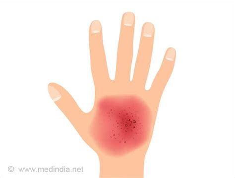 Leukocytosis - Causes Symptoms Diagnosis Treatment