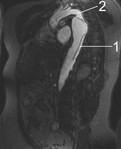 Aortic dissection MRI - wikidoc