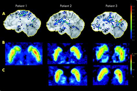 Primary lateral sclerosis presenting parkinsonian symptoms without nigrostriatal involvement ...