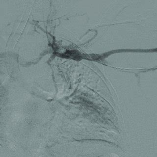 Acute and subacute thrombus retrieved with Inari ClotTriever ...