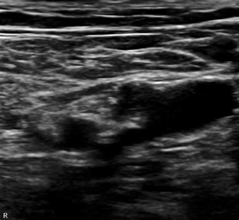 emDOCs.net – Emergency Medicine EducationUltrasound-Guided Femoral Nerve Block - emDOCs.net ...