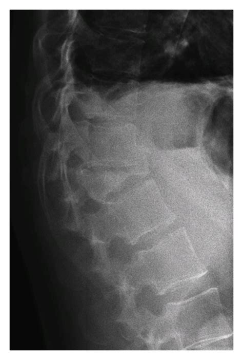 X-ray showing a burst fracture of T12. | Download Scientific Diagram