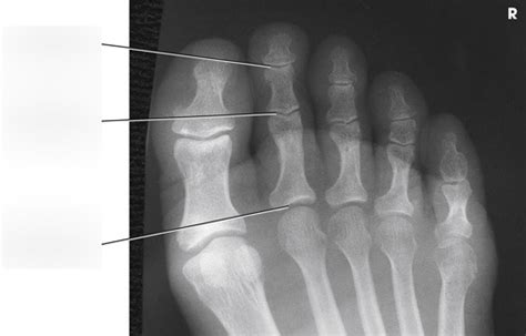 RT10 Anatomy and Projections 6 (Toes) Diagram | Quizlet