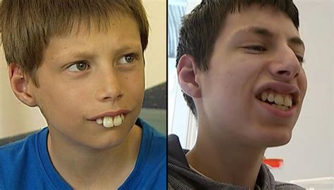 Bullied buck-toothed kid finally gets his perfect smile | Newshub