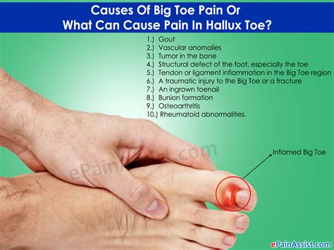 gout symptoms big toe