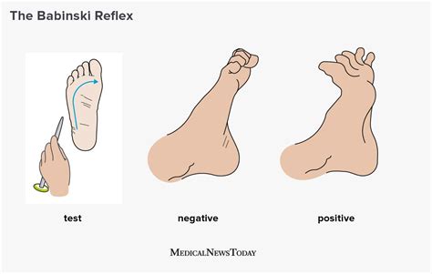 What is the Babinski reflex?