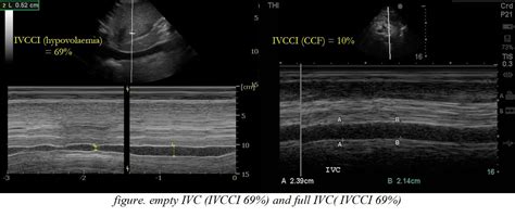 3 IVC Ultrasound Pre-reading for FCUS Course - Intensive Care Network