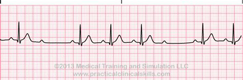 Conduction Disorders (PEARLS) | SMARTY PANCE