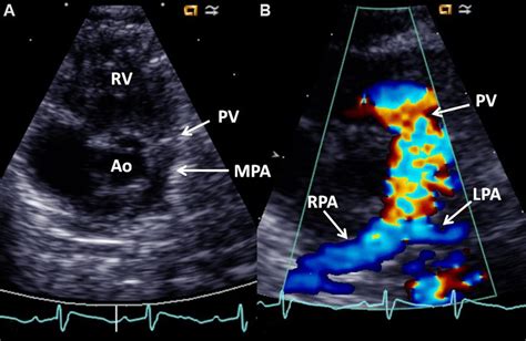 (A) Selected video frame from a 2D echocardiogram in a parasternal... | Download Scientific Diagram