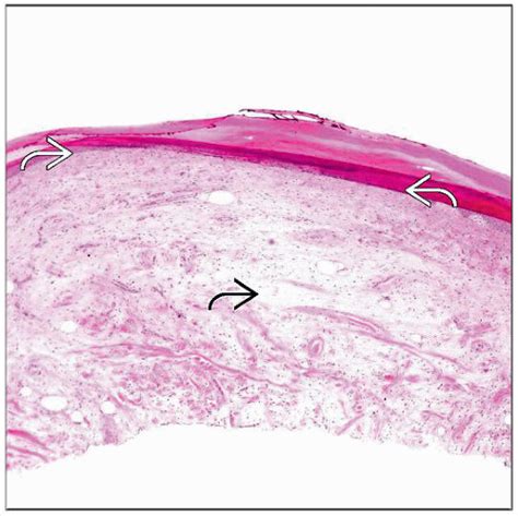 Digital Mucous Cyst Histology