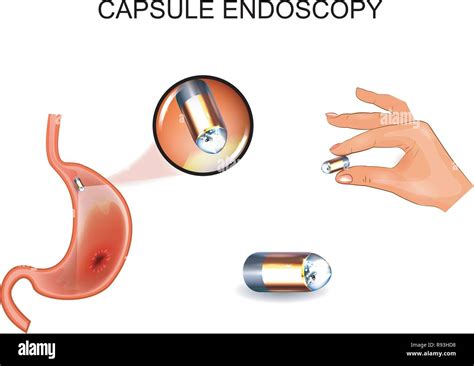 Capsule endoscopy hi-res stock photography and images - Alamy