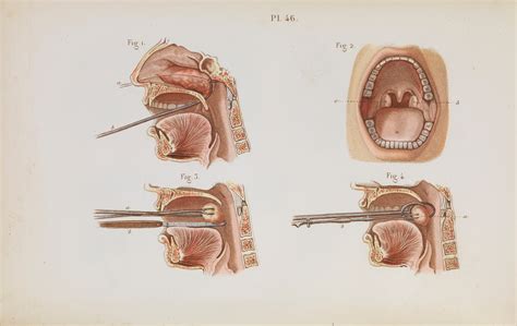 Plate 46, The removal of nasal polyps and tonsillectomy. | Wellcome Collection