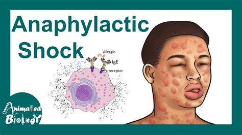 Anaphylactic shock | Anaphylactic Reaction: Symptoms and Treatment - YouTube