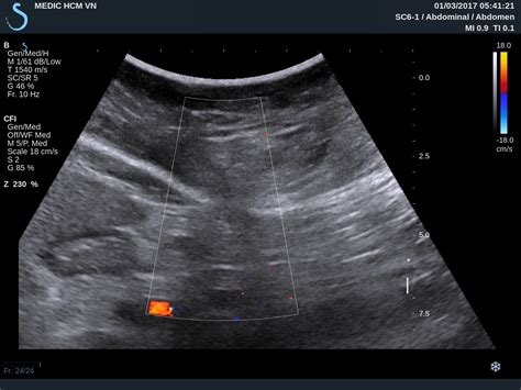 VIETNAMESE MEDIC ULTRASOUND: CASE 421: EPIGASTRIC HERNIA, Dr PHAN THANH ...