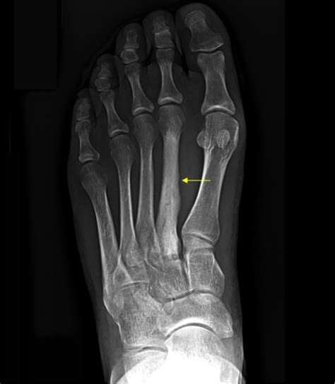 Hairline fracture - learninggola