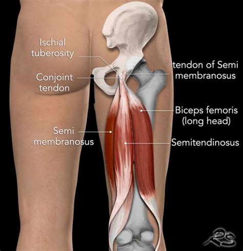 Proximal Hamstring Tendon Rupture