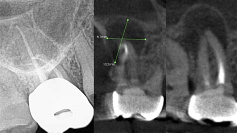 Why Cone Beam CT Scan (CBCT) is a Must for Diagnosis of Teeth-Related Infections | Why Cone Beam ...