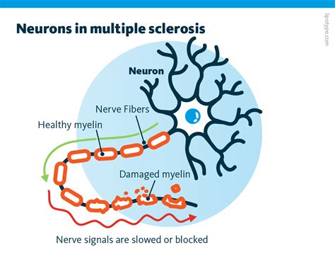 Lipid biomarkers for multiple sclerosis - Neuroinflammation and Lipidomics - Lipotype GmbH