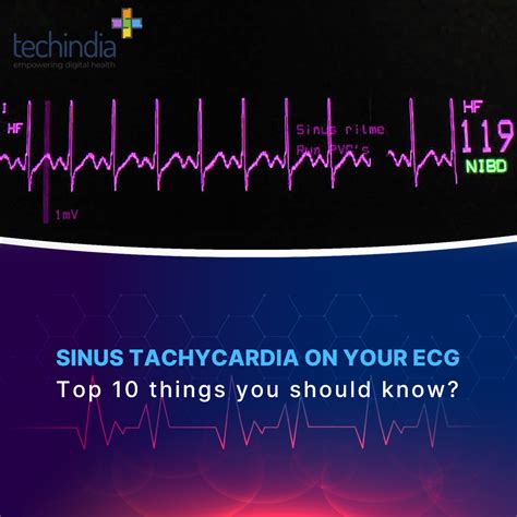 Sinus Tachycardia on your ECG: Top 10 things you should know? | Cardiac Event Monitoring ...