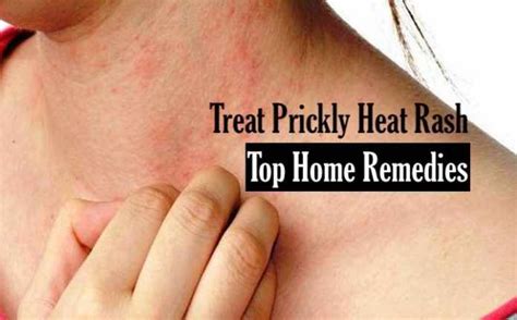 Causes, Symptoms, and Treatments for Heat Rash You Can Do At Home