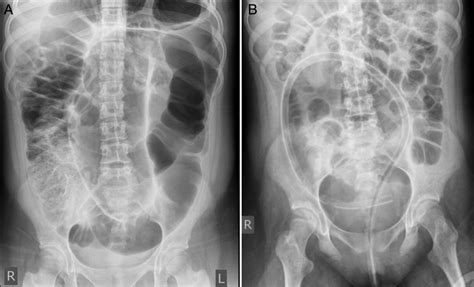 Sigmoid volvulus in an adolescent girl: staged management with ...