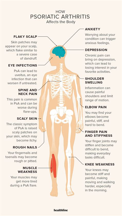 Five types of psoriatic arthritis – Artofit