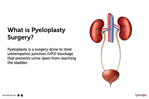 Pyeloplasty Surgery: Purpose, Procedure, and Benefits and Side Effects