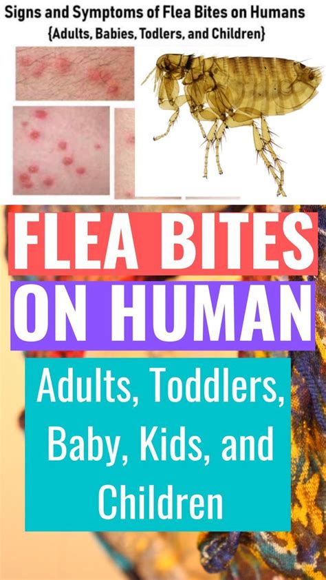 Flea Bites on Humans: What Do Fleabites Symptoms Really Look Like? Bug Bites Remedies, Flea ...