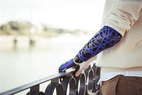 UNYQ introduces 3D printed upper limb prosthetic covers - Australian Manufacturing