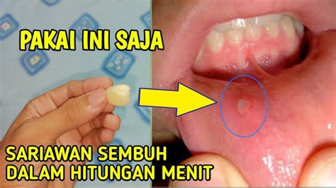 OBAT SARIAWAN PALING AMPUH !! CARA MENGOBATI SARIAWAN SECARA ALAMI ...