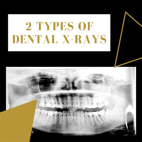 2 Types of Dental X-Rays | Southwest Family Dentistry