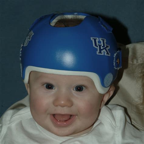 Plagiocephaly - Kentucky Center for Cosmetic & Reconstructive Surgery