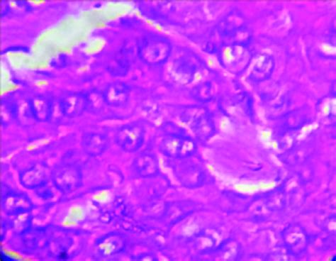 Papillary carcinoma of the thyroid. The microscopic appearance of a ...