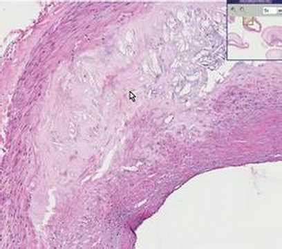 Histopathology Coronary arteries--Atherosclerosis - YouTube