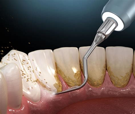 Pros and Cons of laser gum surgery vs traditional gum disease treatmnent