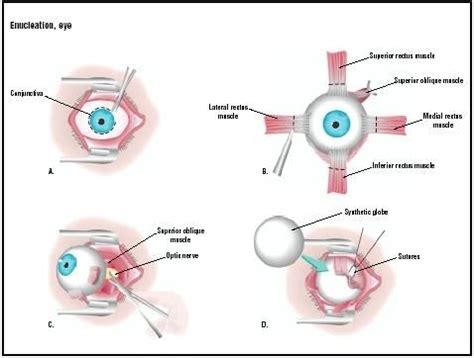 Enucleation is the surgical removal of the eyeball that leaves the eye ...