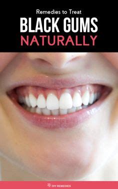 Black Gums: Natural Healty Tips to get rid of them | Skin care recipes ...