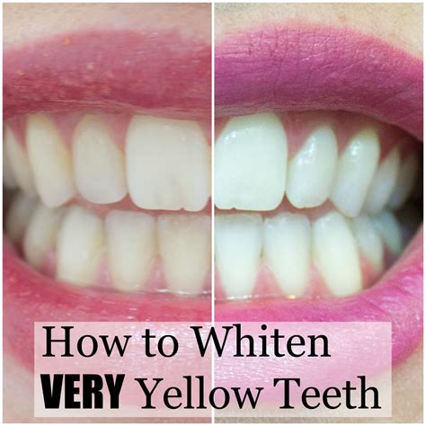 How to Whiten Very Yellow Teeth at Home | Seattle Stylista